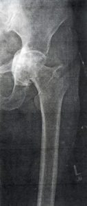 Pre-op hip x-ray showing femur protrusion into pelvis